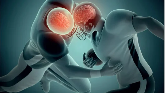 concussion